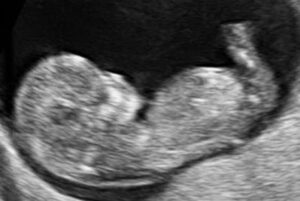 11 weken zwanger - Echo 11 weken - Kraamzorg So Cute