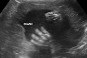 17 weken zwanger - Echo 17 weken - Kraamzorg So Cute