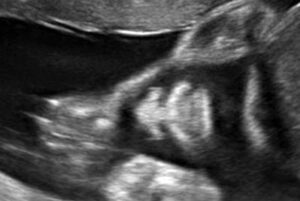 26 weken zwanger - Echo 26 weken - Kraamzorg So Cute