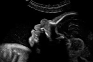 29 weken zwanger - Echo 29 weken - Kraamzorg So Cute