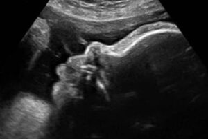 36 weken zwanger - Echo 36 weken - Kraamzorg So Cute