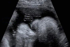 39 weken zwanger - Echo 39 weken - Kraamzorg So Cute