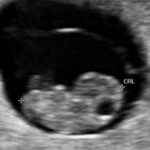 Het ultrasonbeeld van de baby in week 8 is opwindend, omdat je kunt zien dat de baby beweegt. Sommige baby's laten zelfs bewegingen zien in de armen en benen. Hoewel de aanstaande moeder deze bewegingen nog niet zal voelen, is het fascinerend om te zien.
